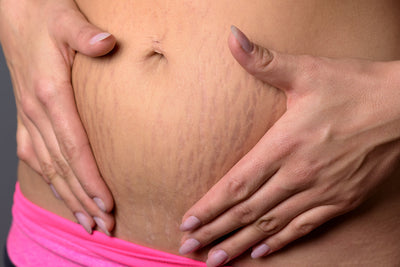 Tattooing Stretch Marks: How It Works and Why You Might Want To Try It
